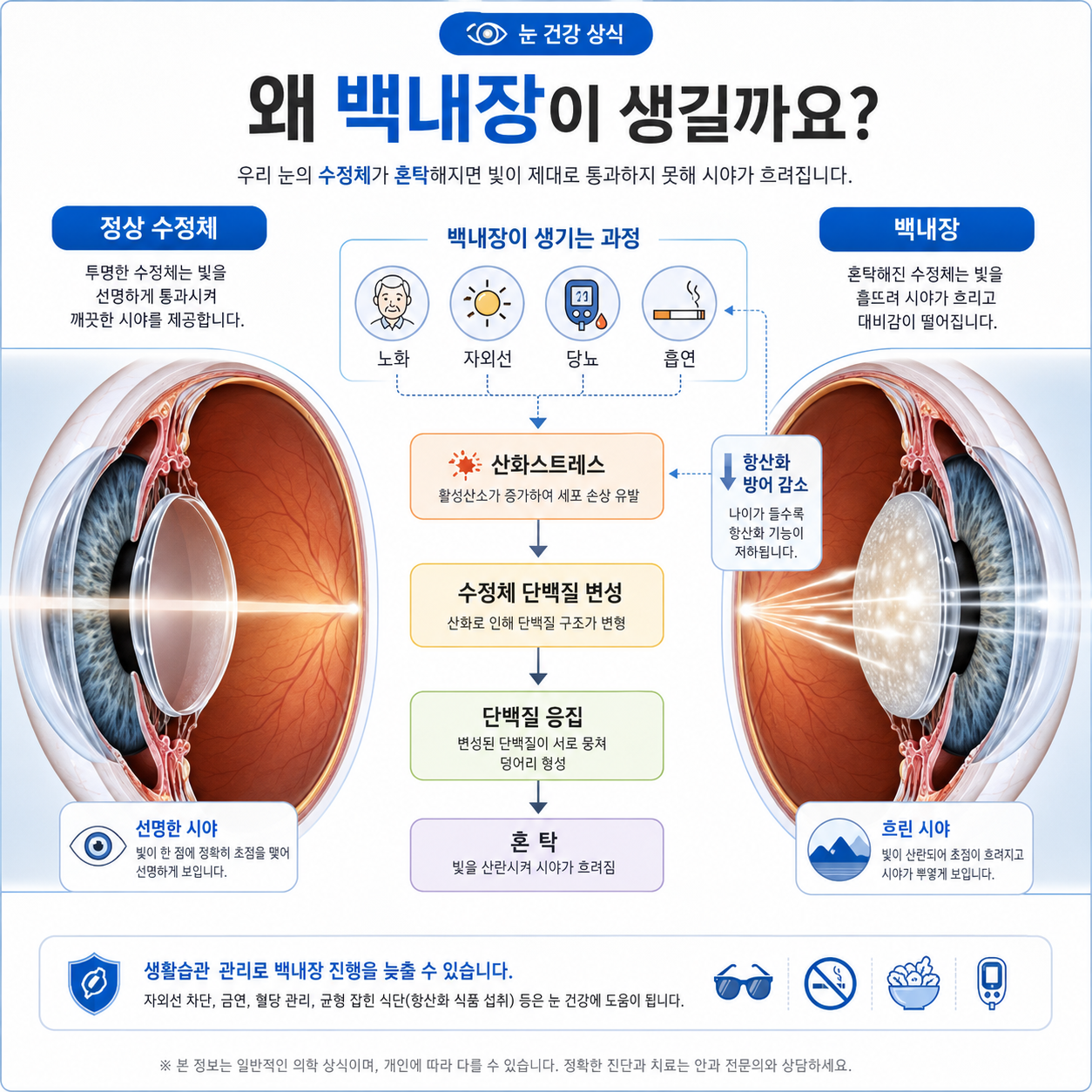 군포 백내장 수술안과] 백내장의 원인, 수정체가 뿌옇게 변하는 이유는?