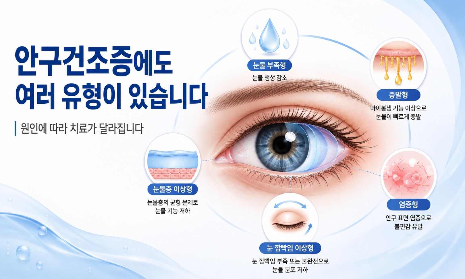 산본 안구건조증의 여러 유형과 원인을 설명하는 건강정보