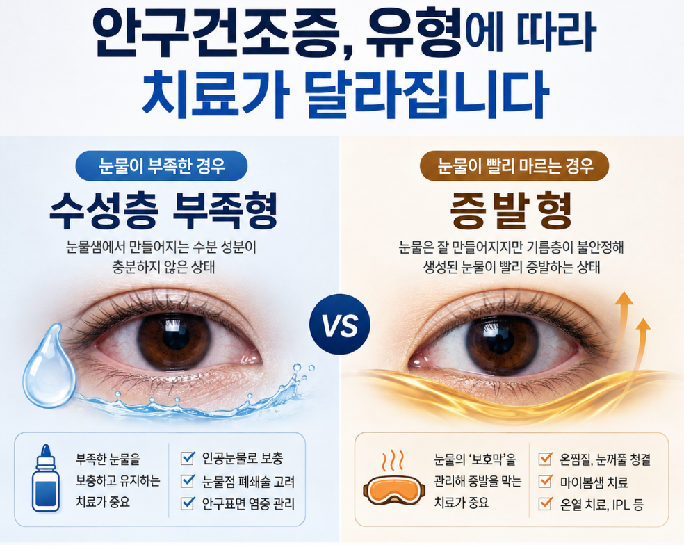 산본 안구건조증 눈물 부족형과 증발형의 차이와 치료 방법