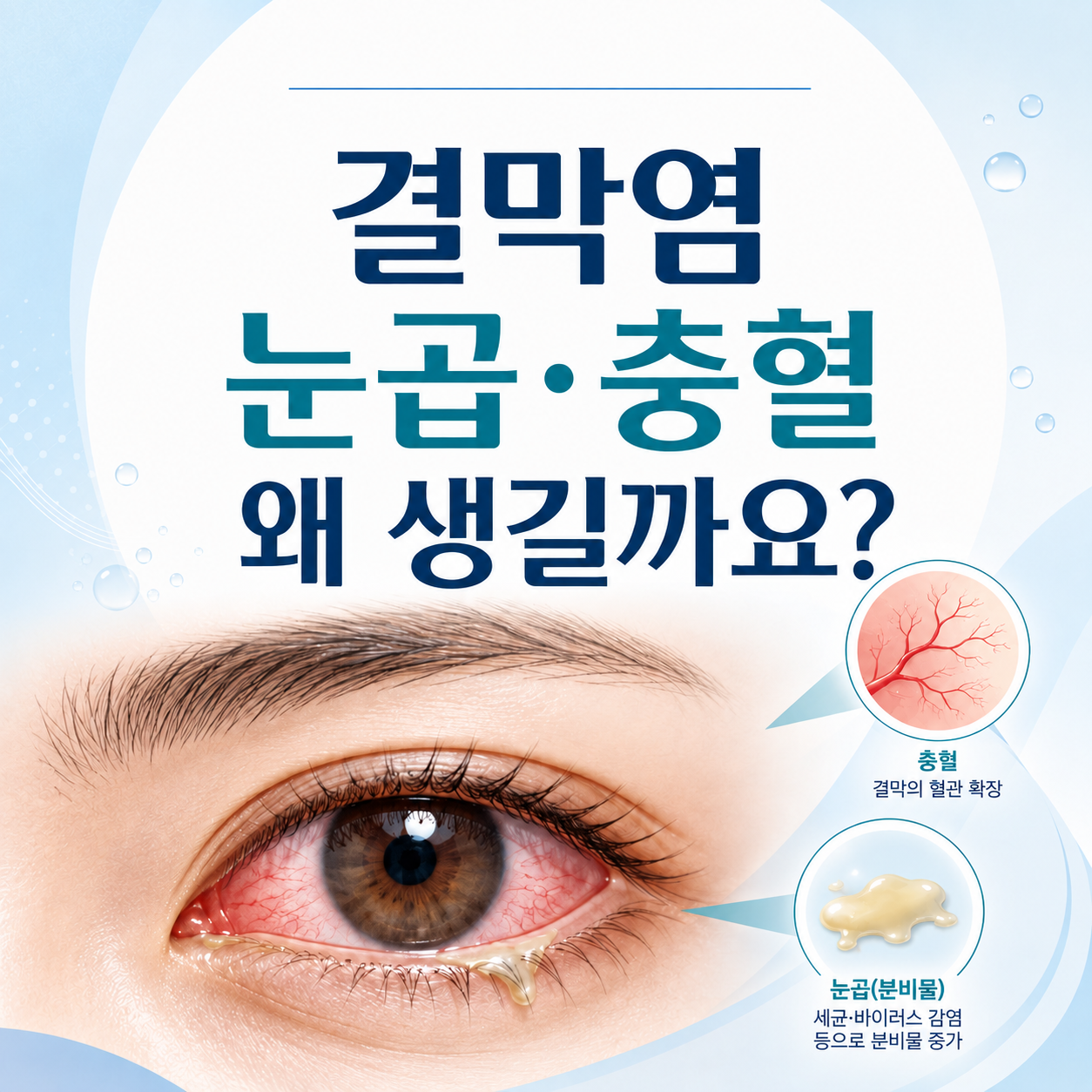 범계역안과 결막염이 생기면 왜 눈곱이 많이 생기고 눈이 충혈될까요?