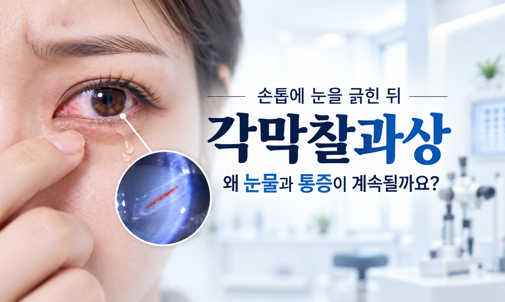 손톱에 긁혀 각막 표면의 상피가 손상된 상태를 설명하는 그림