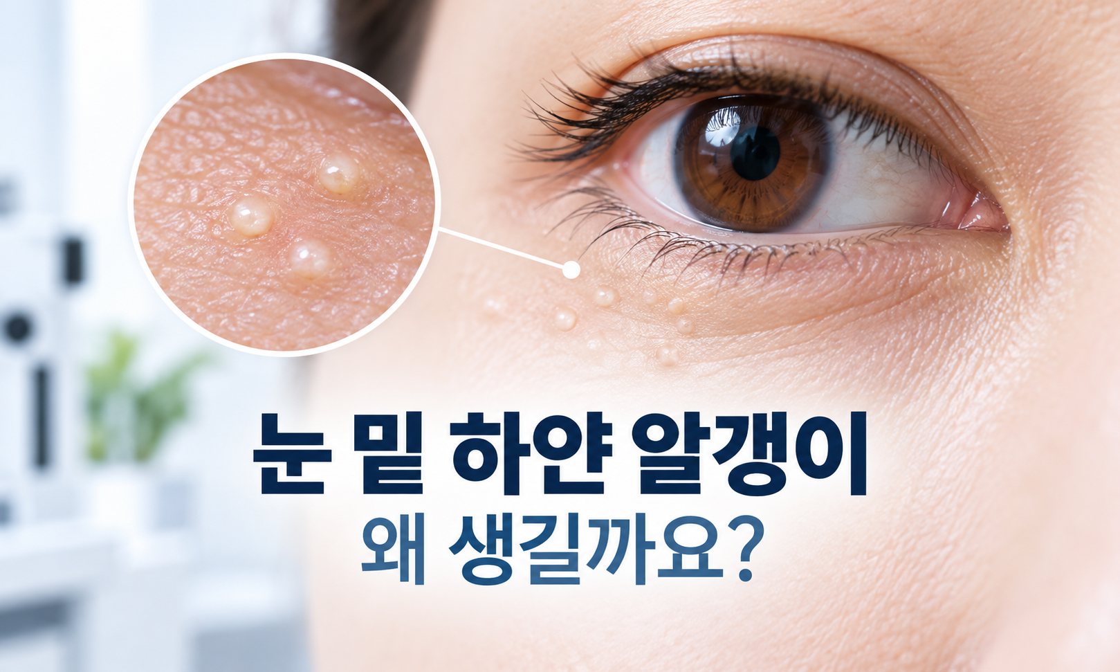 눈 밑 피부에 작은 흰색 비립종이 보이는 모습